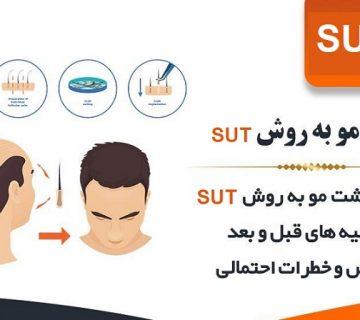 کاشت مو به روش SUT