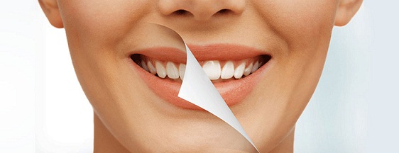 سفید کردن دندان یا بلیچینگ در تبریز
