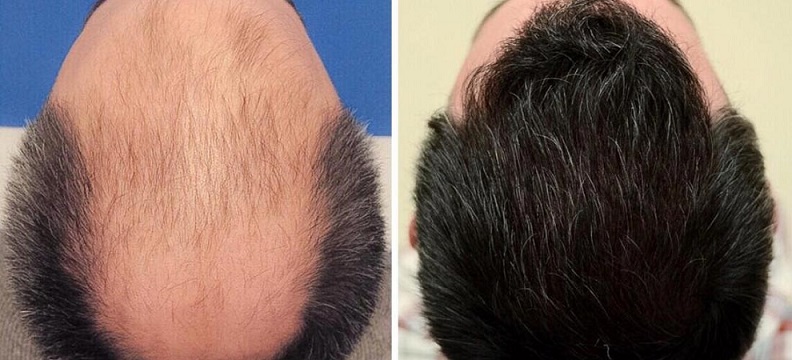 تاریخچه کاشت مو
