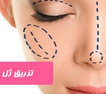 تزریق ژل زاویه فک در تبریز