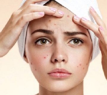 روشهای رفع سریع جوش صورت 