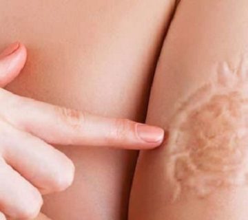 روش های مدرن برای درمان جای زخم