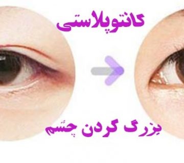 عمل کانتوپلاستی در تبریز