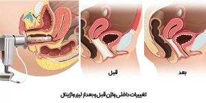کاربردهای زیبایی لیزر مونالیزاتاچ