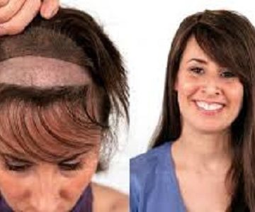 پروتز مو در تبریز