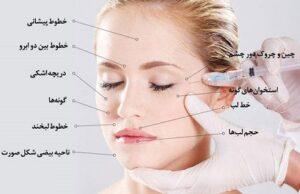 انواع محل های تزریق ژل