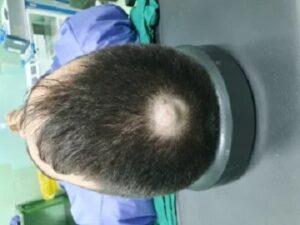 جراحی کیست سباسه در تبریز
