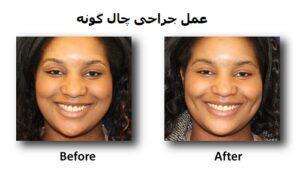 جراحی چال گونه