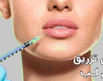 تزریق ژل لب