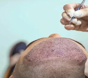 روشهای کاشت مو